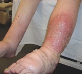 Differentiating between cellulitis/erysipelas and alternative causes of ‘red legs’