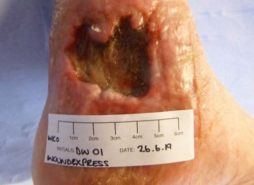 Wound Express Ulcer 1