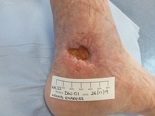 Wound Express Ulcer 2