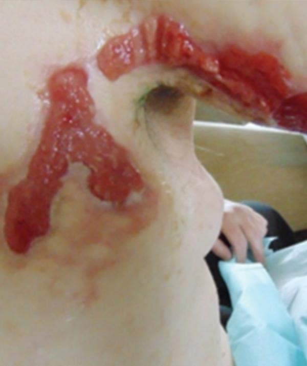 Wound Care Today