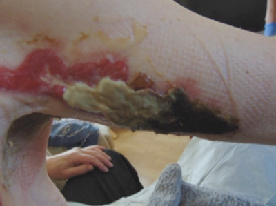 Wound-dressings-case-study1.1