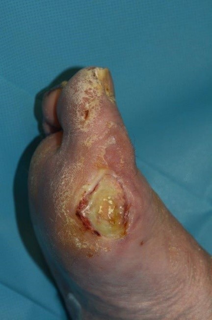 Wound-dressings-case-study