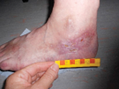 Figure 1 shows a typical presentation of a venous leg ulcer. Treatment involves compression of the leg and a wound dressing appropriate for the ulcer.