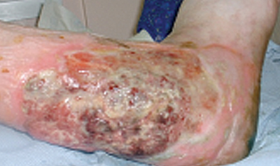 Figure 10. Ulcer caused by squamous cell carcinoma.