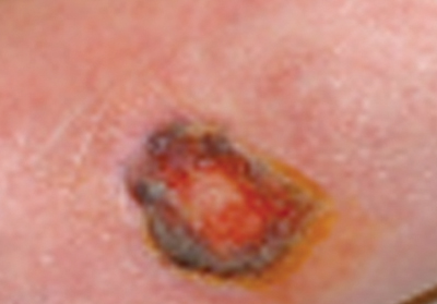 Figure 3. Ulcer due to pyoderma gandrenosum.