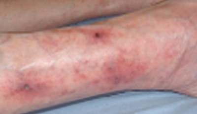 Figure 4. Ulcer due to small vessel vasculitis.