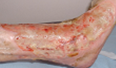 Figure 5. Rheumatoid ulcer.
