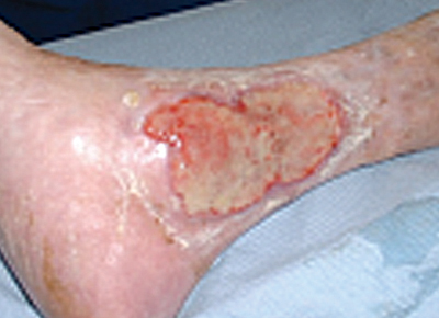 Figure 6. Rheumatoid ulcer.