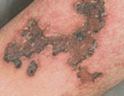 Figure 7. Ulcer due to calciphylaxis.