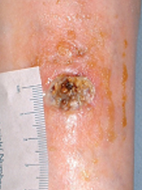 Figure 8. Ulcer due to calcinosis cutis.