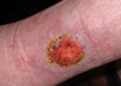 Figure 9. Lesion due to basal cell carcinoma.