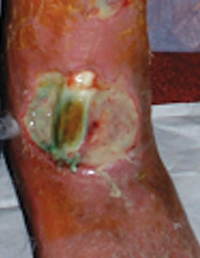 Figure 2. Arterial ulcer