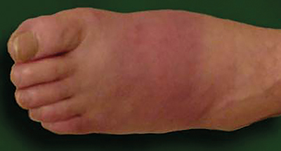 Figure 3. Charcot neuro-osteoarthropathy.