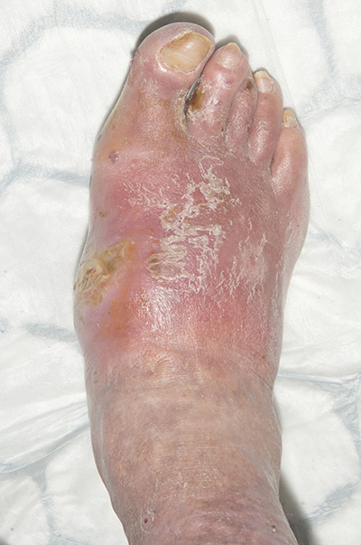 Figure 5. Foot five days later. Photographs reproduced courtesy of Salford Royal NHS Foundation Trust.