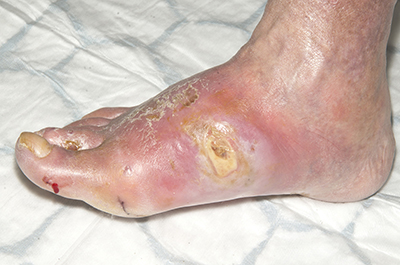 Figure 5. Foot five days later. Photographs reproduced courtesy of Salford Royal NHS Foundation Trust.