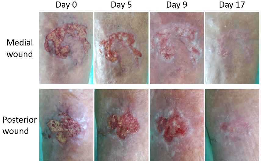 The wound healing progression in time during L-Mesitran treatment